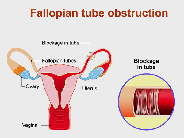 blocked-fallopian-tubes-img1-delhi-ivf blocked-fallopian-tubes-img1-delhi-ivf