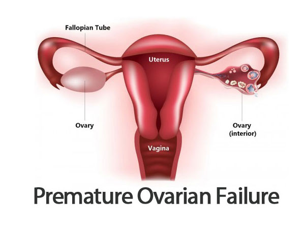 premature-ovarian-failure-img1-delhi-ivf premature-ovarian-failure-img1-delhi-ivf
