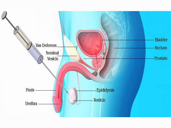 testicular-biopsy-img1-delhi-ivf testicular-biopsy-img1-delhi-ivf